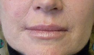 Valentine lip lift Case 6321 After Photo Valentine lip lift