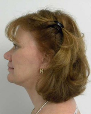 Neck Lift Case 6332 After Photo Neck Lift