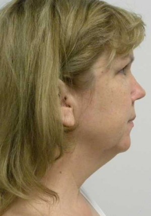 Neck Lift Case 6341 Before Photo Neck Lift