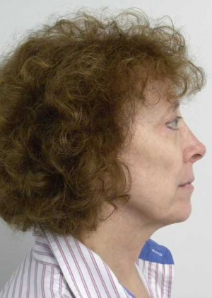 Neck Lift Case 6344 Before Photo Neck Lift