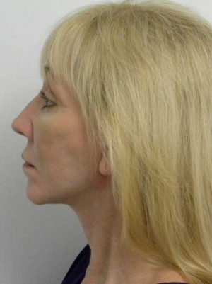 Neck Lift Case 6347 After Photo Neck Lift