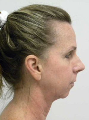 Neck Lift