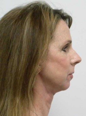 Neck Lift