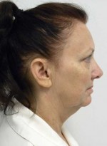 Neck Lift