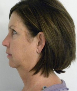 Neck Lift Case 6359 Before Photo Neck Lift