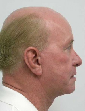 Neck Lift Case 6362 After Photo Neck Lift
