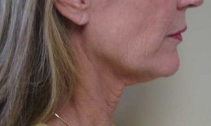 Neck Lift Case 6365 Before Photo Neck Lift