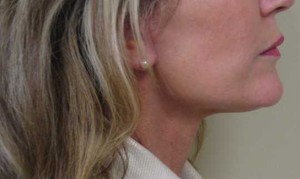 Neck Lift Case 6365 After Photo Neck Lift