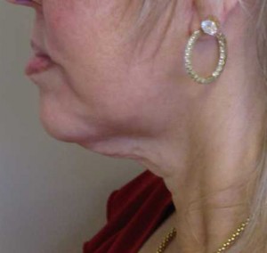 Neck Lift Case 6368 Before Photo Neck Lift