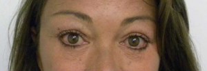 Eyelid Surgery Case 6372 After Photo Eyelid Surgery