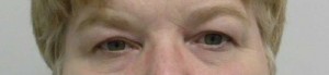 Eyelid Surgery Case 6375 Before Photo Eyelid Surgery