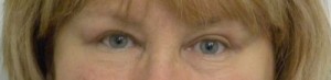 Eyelid Surgery Case 6381 After Photo Eyelid Surgery