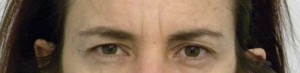 Eyelid Surgery Case 6384 Before Photo Eyelid Surgery