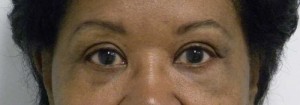 Eyelid Surgery Case 6387 After Photo Eyelid Surgery