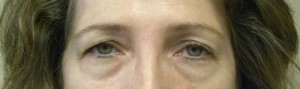 Eyelid Surgery Case 6390 Before Photo Eyelid Surgery