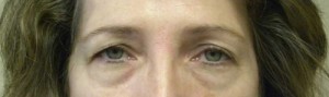 Eyelid Surgery