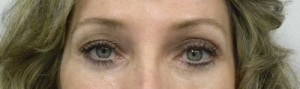 Eyelid Surgery Case 6390 After Photo Eyelid Surgery