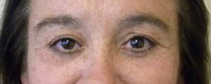 Eyelid Surgery Case 6393 After Photo Eyelid Surgery