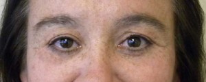 Eyelid Surgery