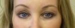 Eyelid Surgery