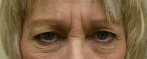Eyelid Surgery Case 6402 Before Photo Eyelid Surgery