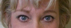 Eyelid Surgery Case 6402 After Photo Eyelid Surgery