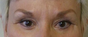 Eyelid Surgery Case 6405 After Photo Eyelid Surgery