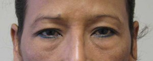 Eyelid Surgery