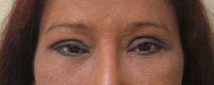 Eyelid Surgery