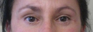 Eyelid Surgery Case 6414 After Photo Eyelid Surgery