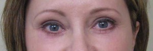 Eyelid Surgery Case 6417 After Photo Eyelid Surgery