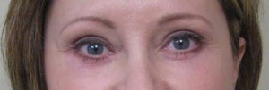 Eyelid Surgery