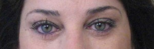 Eyelid Surgery