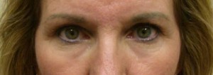 Eyelid Surgery Case 6423 Before Photo Eyelid Surgery