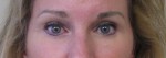 Eyelid Surgery