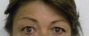 Brow Lift/Forehead Rejuvenation Case 6428 Before Photo Brow Lift/Forehead Rejuvenation