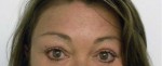 Brow Lift/Forehead Rejuvenation