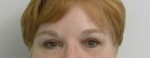 Brow Lift/Forehead Rejuvenation