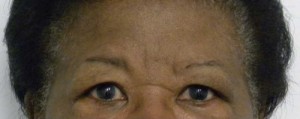 Brow Lift/Forehead Rejuvenation Case 6434 Before Photo Brow Lift/Forehead Rejuvenation