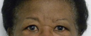 Brow Lift/Forehead Rejuvenation