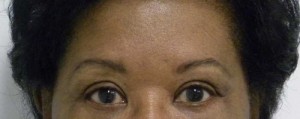 Brow Lift/Forehead Rejuvenation Case 6434 After Photo Brow Lift/Forehead Rejuvenation