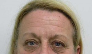 Brow Lift/Forehead Rejuvenation