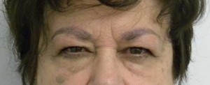 Brow Lift/Forehead Rejuvenation