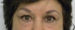 Brow Lift/Forehead Rejuvenation