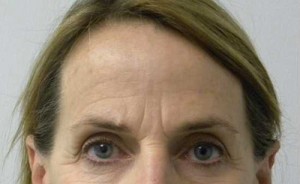 Brow Lift/Forehead Rejuvenation