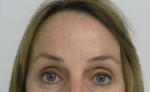 Brow Lift/Forehead Rejuvenation