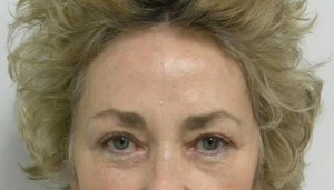 Brow Lift/Forehead Rejuvenation Case 6446 After Photo Brow Lift/Forehead Rejuvenation