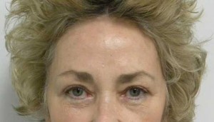 Brow Lift/Forehead Rejuvenation