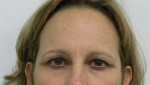 Brow Lift/Forehead Rejuvenation