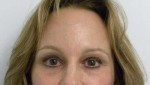 Brow Lift/Forehead Rejuvenation